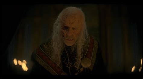 Viserys Face Illness Disease Leprosy House Dragon